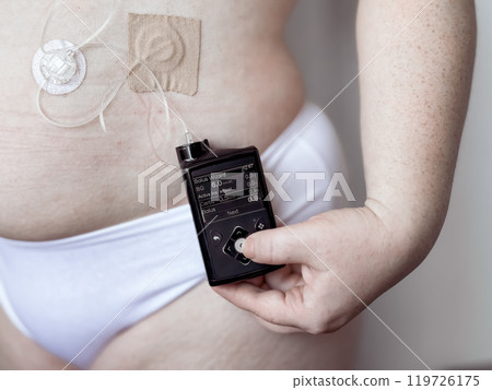 Diabetes care, person using insulin pump for glucose management 119726175