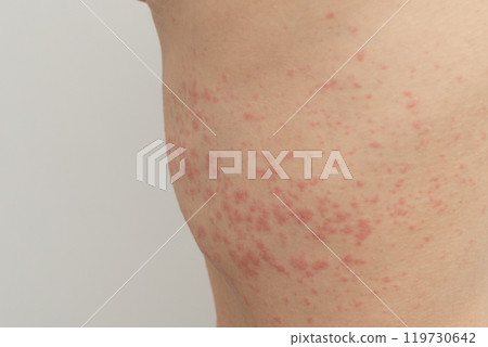 Urticaria is an allergic reaction on the skin. Red spots on the skin Urticaria is an allergic reaction on the skin. Red spots on the skin 119730642
