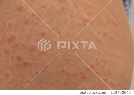 Urticaria allergy on woman legs Urticaria allergy on woman legs 119730643
