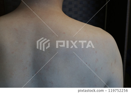 50多歲男性，蕁麻疹，蕁麻疹，出現痱子後3週，去看皮膚科醫生，開藥，原因不明 119752256