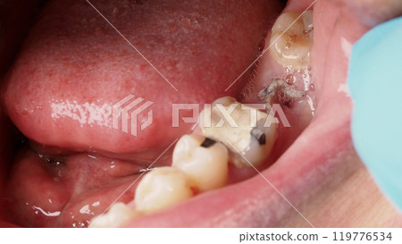 Close up on suture after gum surgery. The molar was extracted and the wound was closed with stitches and adjacent tooth was filled with temporary filling material for root canal treatment. Dental care Close up on suture after gum surgery. The molar was extracted and the wound was closed with stitches and adjacent tooth was filled with temporary filling material for root canal treatment. Dental care 119776534