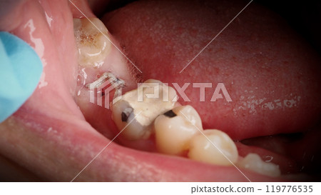 Close up on suture after gum surgery. The molar was extracted and the wound was closed with stitches and adjacent tooth was filled with temporary filling material for root canal treatment. Dental care Close up on suture after gum surgery. The molar was extracted and the wound was closed with stitches and adjacent tooth was filled with temporary filling material for root canal treatment. Dental care 119776535