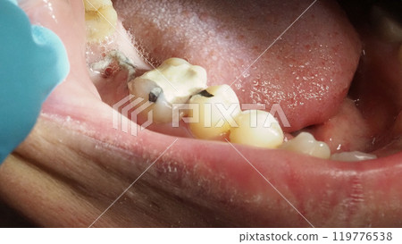Close up on suture after gum surgery. The molar was extracted and the wound was closed with stitches and adjacent tooth was filled with temporary filling material for root canal treatment. Dental care Close up on suture after gum surgery. The molar was extracted and the wound was closed with stitches and adjacent tooth was filled with temporary filling material for root canal treatment. Dental care 119776538
