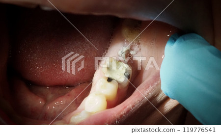 Close up on suture after gum surgery. The molar was extracted and the wound was closed with stitches and adjacent tooth was filled with temporary filling material for root canal treatment. Dental care Close up on suture after gum surgery. The molar was extracted and the wound was closed with stitches and adjacent tooth was filled with temporary filling material for root canal treatment. Dental care 119776541