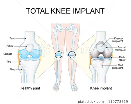 Total knee implant Total knee implant 119778819