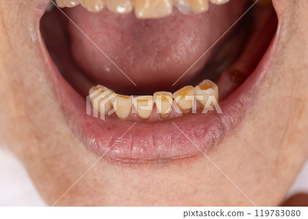 Attrition tooth due to interaction with other teeth in elderly woman. 119783080