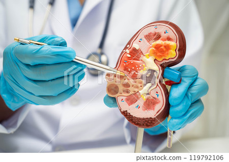 Chronic kidney disease, doctor with model for treatment urinary system, urology, Estimated glomerular filtration rate eGFR. Chronic kidney disease, doctor with model for treatment urinary system, urology, Estimated glomerular filtration rate eGFR. 119792106