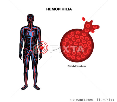 Hemophilia medical poster 119807154
