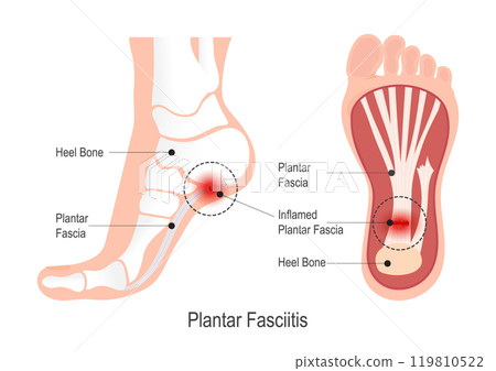 Plantar fasciitis is pain on the bottom of foot. Plantar fasciitis is pain on the bottom of foot. 119810522