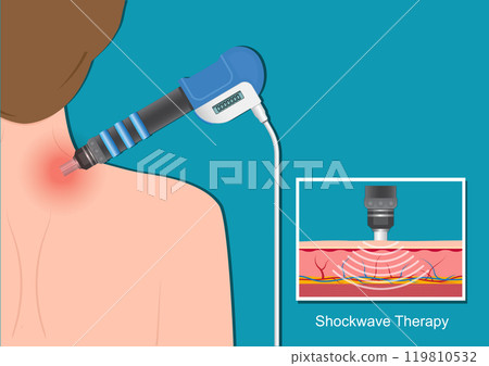 Extracorporeal Shock Wave Therapy. Extracorporeal Shock Wave Therapy. 119810532