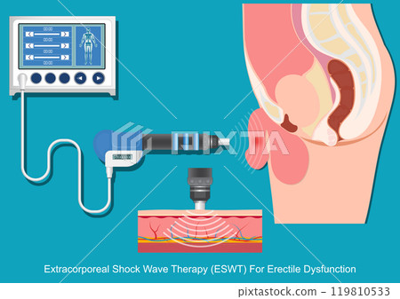 Extracorporeal Shock Wave Therapy (ESWT) For Erectile Dysfunction. 119810533