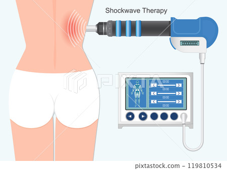 Extracorporeal Shock Wave Therapy for back muscles. 119810534
