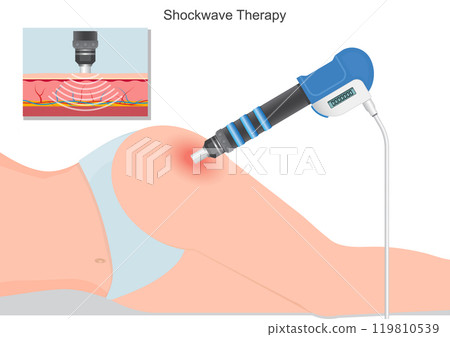 Non invasive Extracorporeal Shock Wave Therapy 119810539