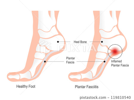 Plantar fasciitis is inflammation in the plantar fascia. Plantar fasciitis is inflammation in the plantar fascia. 119810540