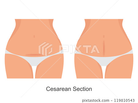 Caesarean section also known as C section. Caesarean section also known as C section. 119810543