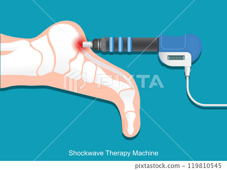 ESWT or Extracorporeal shock wave therapy. 119810545