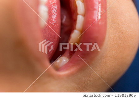 Baby canine tooth fell out Baby canine tooth fell out 119812909