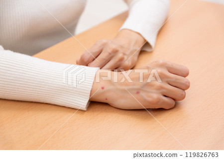 女人的手被跳蚤咬了 女人的手被跳蚤咬了 119826763