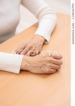 女人的手被跳蚤咬了 女人的手被跳蚤咬了 119826764