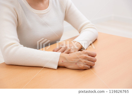 Woman's hand bitten by fleas Woman's hand bitten by fleas 119826765