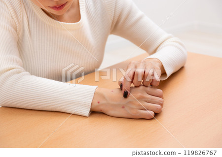 女人的手被跳蚤咬了 119826767