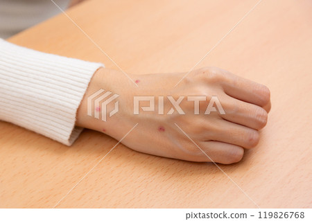 女人的手被跳蚤咬了 女人的手被跳蚤咬了 119826768