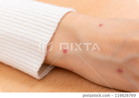 女人的手被跳蚤咬了 女人的手被跳蚤咬了 119826769