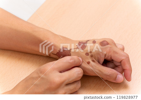 Burn scars 119828977