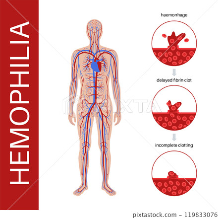 Hemophilia medical poster 119833076