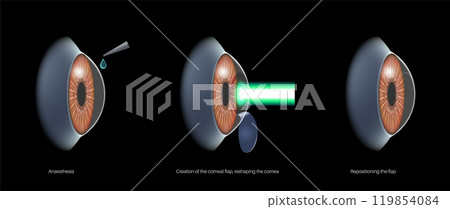 LASIK eye surgery 119854084