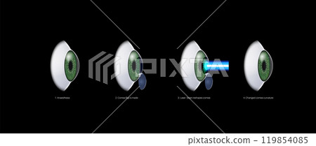 LASIK eye surgery 119854085