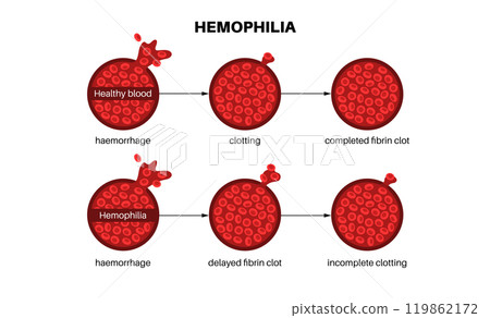 Hemophilia medical poster 119862172