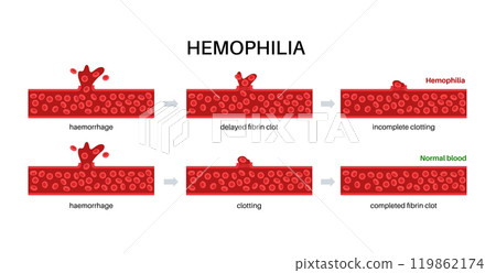 Hemophilia medical poster 119862174