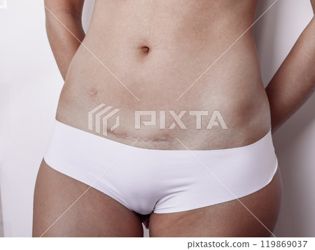 C section scar on female abdomen. Healing, recovery, and strength 119869037
