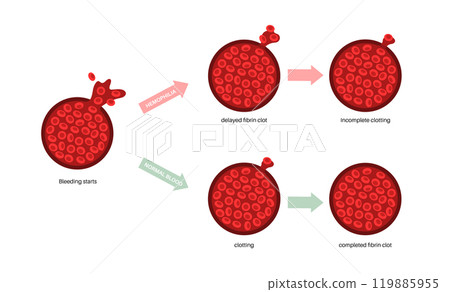 Hemophilia medical poster Hemophilia medical poster 119885955