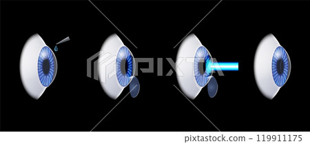 LASIK eye surgery 119911175