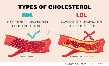 Types of cholesterol in human blood vessels. Normal and narrowed artery for explanation diseases. High-Density Lipoprotein HDL and Low-Density Lipoprotein LDL. Vector illustration 119927436