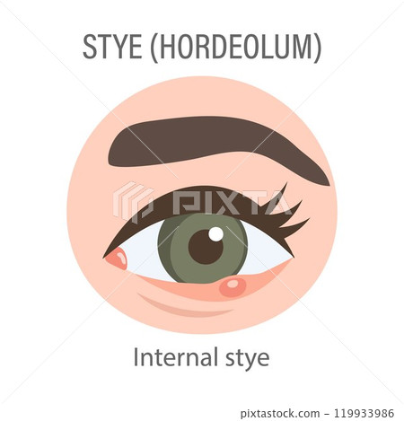 Internal stye of the eye. Medical concept of stye, eye pain, bacterial infection, eye disease. Flat illustration, infographic banner 119933986