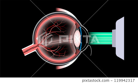 LASIK eye surgery 119942317