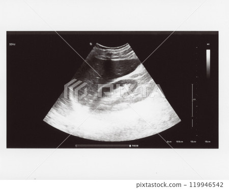 full abdomen ultrasound sonogram full abdomen ultrasound sonogram 119946542