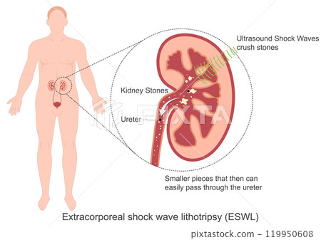Lithotripsy is a common nonsurgical procedure 119950608