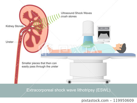 Lithotripsy is a noninvasive procedure. 119950609