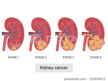 Staging is the process of finding out how far cancer has spread. 119950615