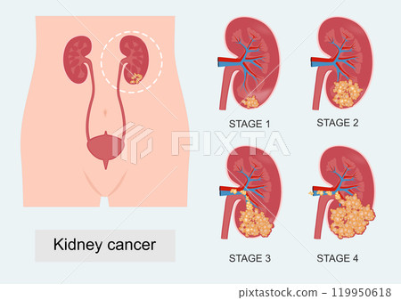 The stage describes how much cancer is in the body. 119950618