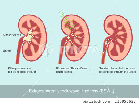 Extracorporeal shock wave lithotripsy (ESWL). Extracorporeal shock wave lithotripsy (ESWL). 119950623