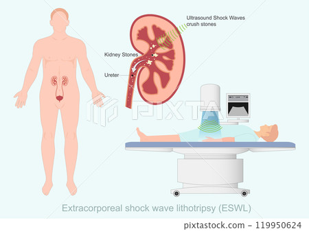 Extracorporeal shock wave lithotripsy (ESWL) is a way. 119950624