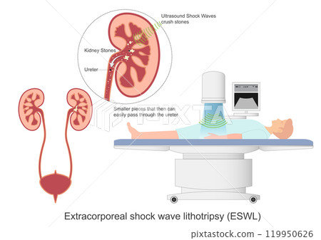 Extracorporeal shock wave lithotripsy ESWL. Extracorporeal shock wave lithotripsy ESWL. 119950626