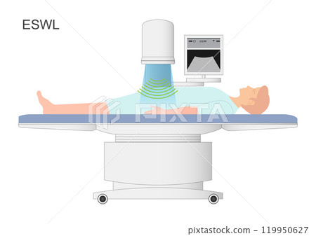 Extracorporeal shockwave lithotripsy (ESWL) is a minimally invasive surgical. 119950627