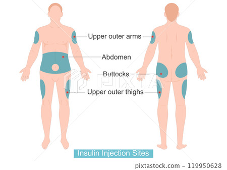 Human outlines showing injection sites on front. 119950628