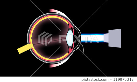 LASIK eye surgery LASIK eye surgery 119973312